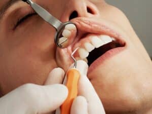 dental fillings