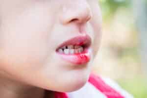 Close-up of a child's mouth with a little bit of blood after an injury at school.